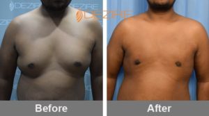 Gyno Before After In Pune