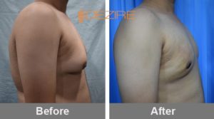 Recovery After Gynecomastia Surgery In Pune