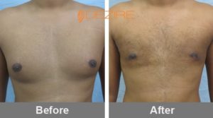 male breast reduction treatment
