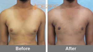 male breast reduction surgery price