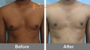 Mens Chest Liposuction Before And After In Pune