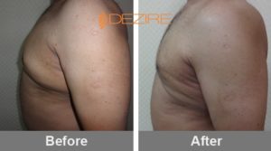 Male Breast Surgery Before And After In Pune