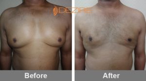 Male Breast Liposuction Before And After In Pune