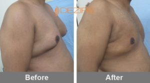 Male Gynecomastia Surgery Before And After In Pune