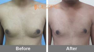 Breast Reduction Before And After-min