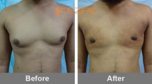 Severe Gynecomastia Before And After In Pune