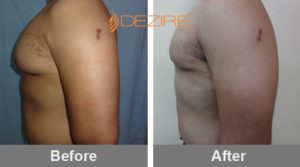 Recovery Time After Gynecomastia Surgery In Pune