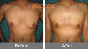 Chest Fat Removal Surgery Cost In India-min