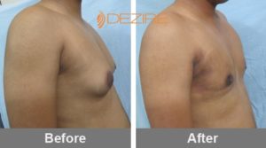 Gynecomastia Before And After Weight Loss In Pune