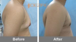 Male Chest Reduction Before And After In Pune