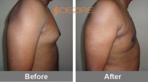 Gynecomastia Surgery Results Before After In Pune