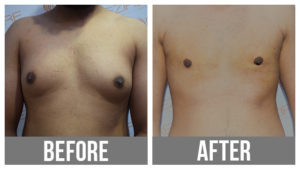 After Gynecomastia Surgery In Pune