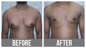 male breast reduction procedure