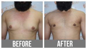 Gyne Before After Male Breast Liposuction
