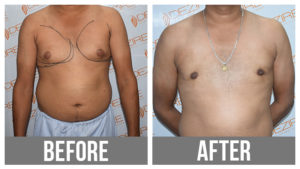 Gyne Before After breast reduction surgery